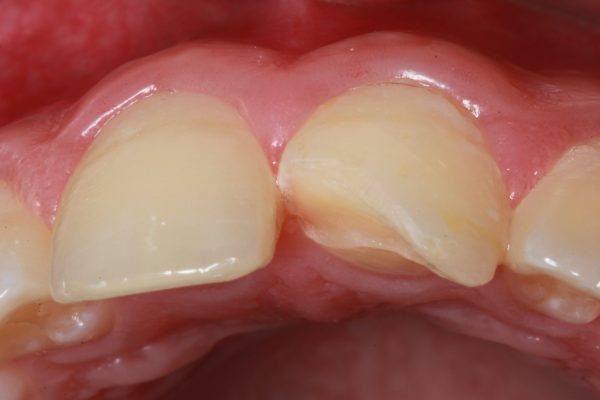 RECONSTRUÇÃO DENTÁRIA IMEDIATA APÓS FRATURA