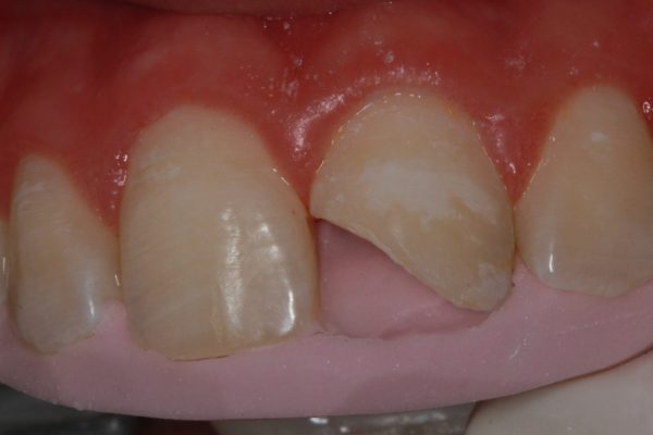 RECONSTRUÇÃO DENTÁRIA IMEDIATA APÓS FRATURA